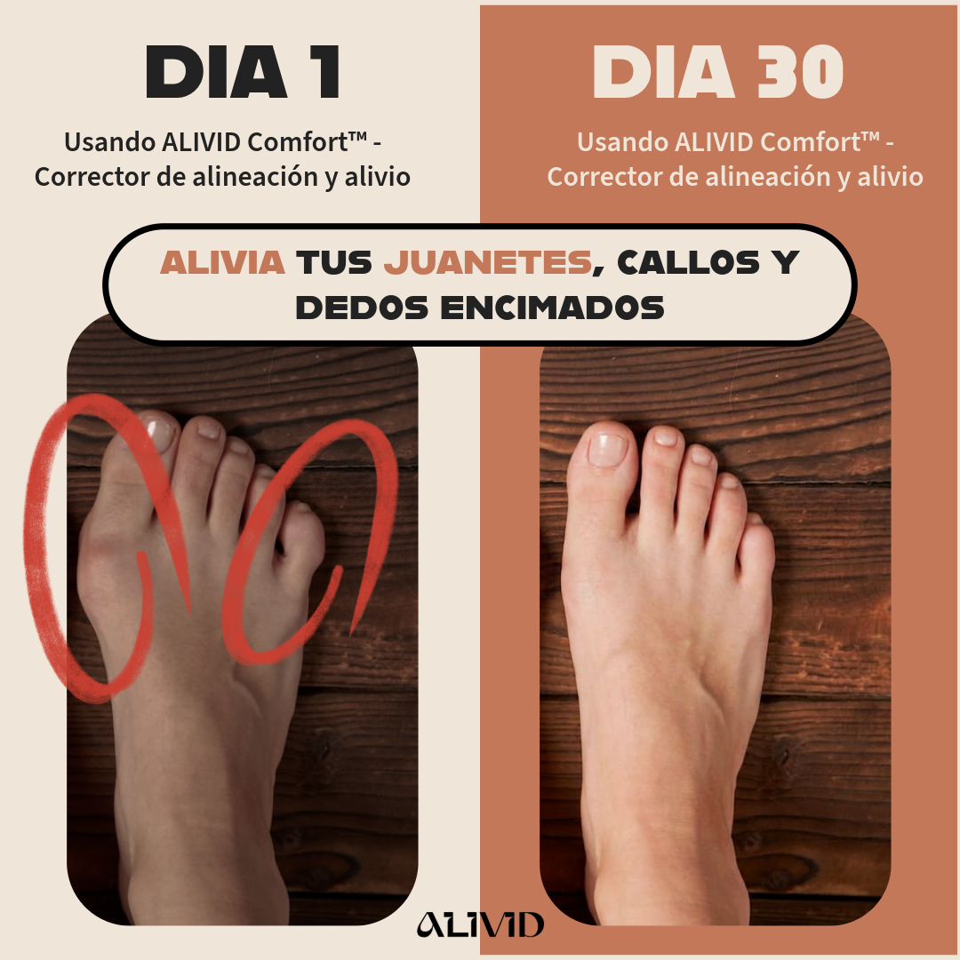 ALIVID Comfort™ - Corrector de alineación y alivio para dedos y juanetes